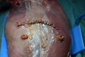 Laparotomy With Ileostomy Formation