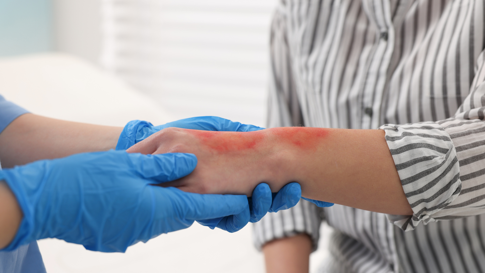 Burns First Aid