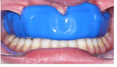 Mouthguard